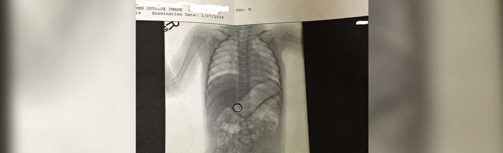 Baby�s X-ray solves mystery of mom�s missing wedding ring